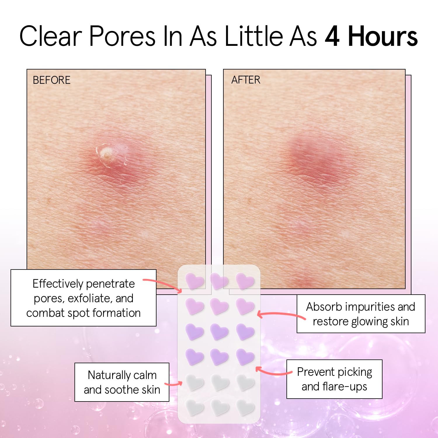 grace & stella Award Winning Pimple Patches for Face - Dermatologist Tested Acne Patches - Hydrocolloid Patch for Breakouts, Whiteheads - Vegan Acne Spot Treatment for Face (Hearts, 216 Pack) - Image 2