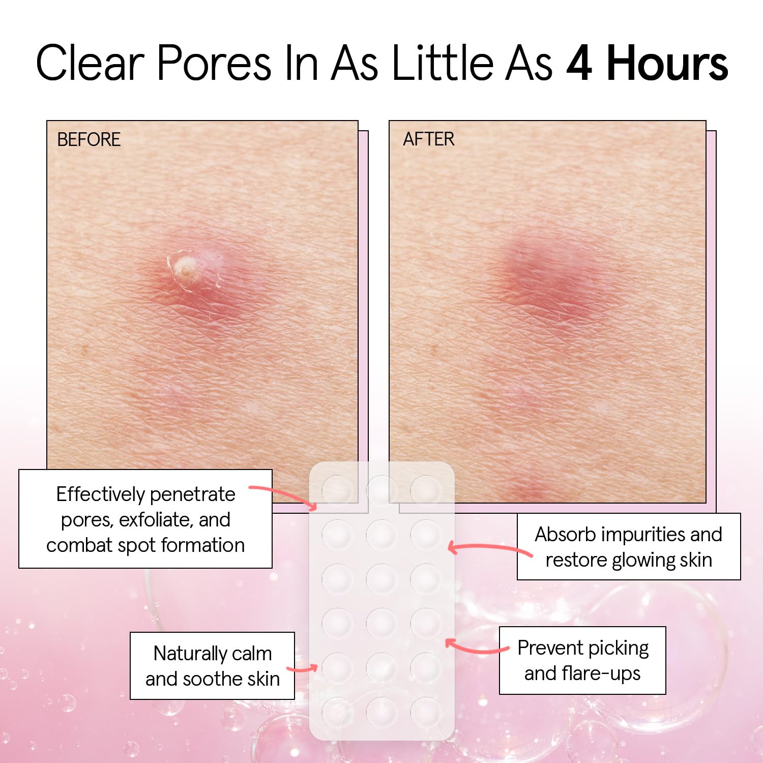 grace & stella Award Winning Pimple Patches for Face - Dermatologist Tested Acne Patches - Hydrocolloid Patch for Breakouts, Whiteheads - Vegan Acne Spot Treatment for Face (Invisible, 216 Count) - Image 2