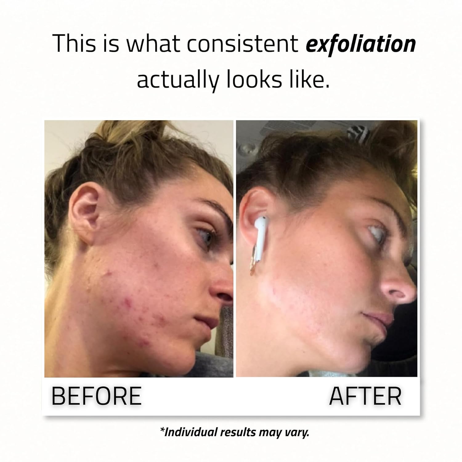 YEOUTH Glycolic Acid Face Peel 30% with Retinol and Green Tea 2oz | Glycolic Acid Peel for Smoother-Looking Skin, Targets the Appearance of Uneven Texture and Dull Skin - Image 2