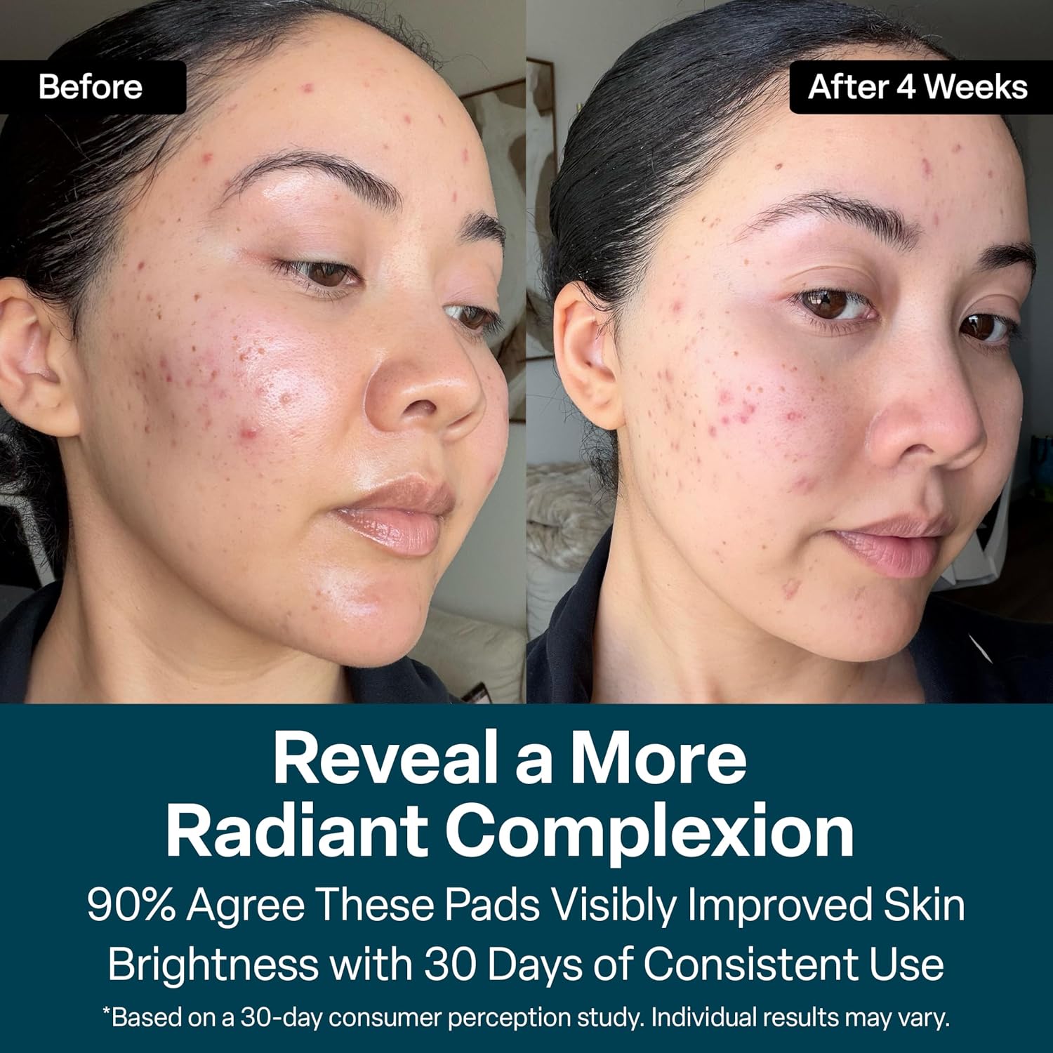 QRxLabs Glycolic Acid Pads - 20% Resurfacing Pads AHA for Face & Body - Exfoliates Skin Surface and Reduces Appearance of Fine Lines and Wrinkles - Acne Treatment Clearing - Daily Pads - 50ct - Image 3
