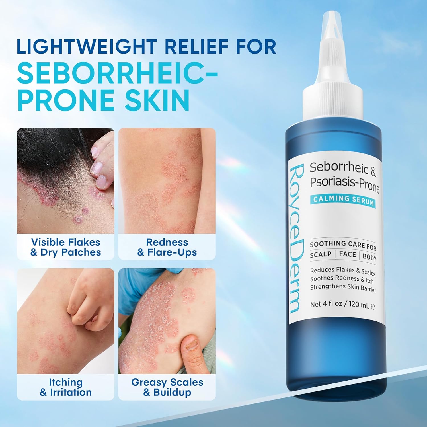 Roycederm Seborrheic & Psoriasis Calming Serum: Clinically Inspired Care for Itch, Dryness, Redness & Flaking - Seborrheic Dermatitis & Psoriasis Scalp Treatment Suitable for Scalp, Face & Body - Image 3