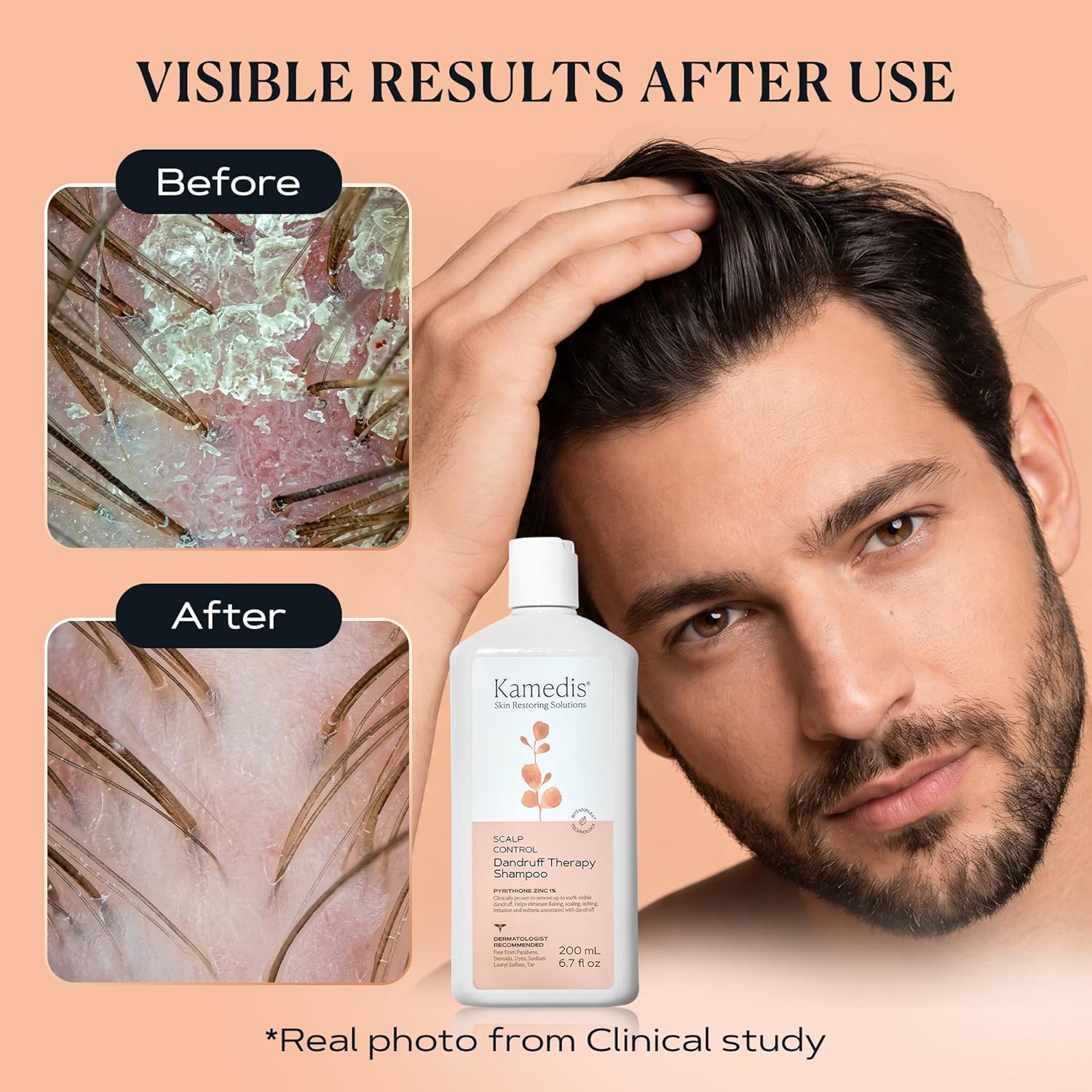 KAMEDIS Scalp Savior – Itchy Dry Scalp Treatment & Seborrheic Dermatitis Relief. Anti Dandruff Shampoo Clinically Formulated With Zinc Pyrithione & Salicylic Acid. Gentle SLS Free Formula. 16.9 Fl Oz - Image 3