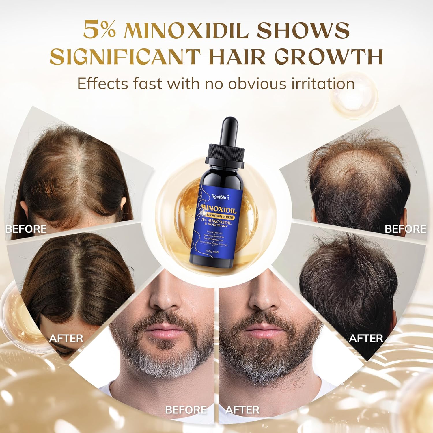 5% Minoxidil Hair Growth Serum for Men Women, with Rosemary &Biotin, Hair Loss Treatment Extract Support Thicker Fuller Healthier Hair Texture - 2 Fl Oz - Image 3
