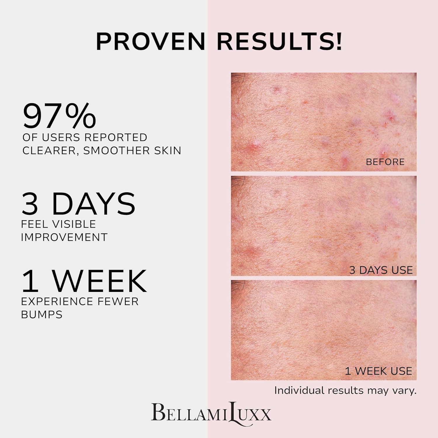 BellamiLuxx Butt Acne Clearing Treatment Cream: Body Acne Treatment for Folliculitis and Pimples on Buttocks, Thighs, and Body with 2% Salicylic Acid & Tea Tree Oil - Butt Cream for Smooth Skin - Image 3